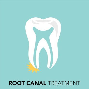 rootcanal treatment